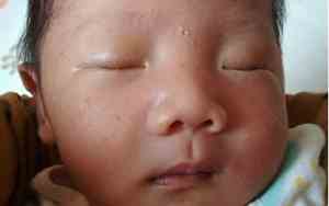 刚出生宝宝脸上长黄斑
