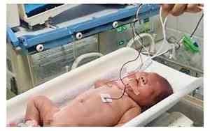 超低出生体重儿