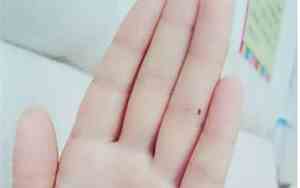 左手无名指长痣