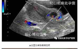 疤痕妊娠成功出生